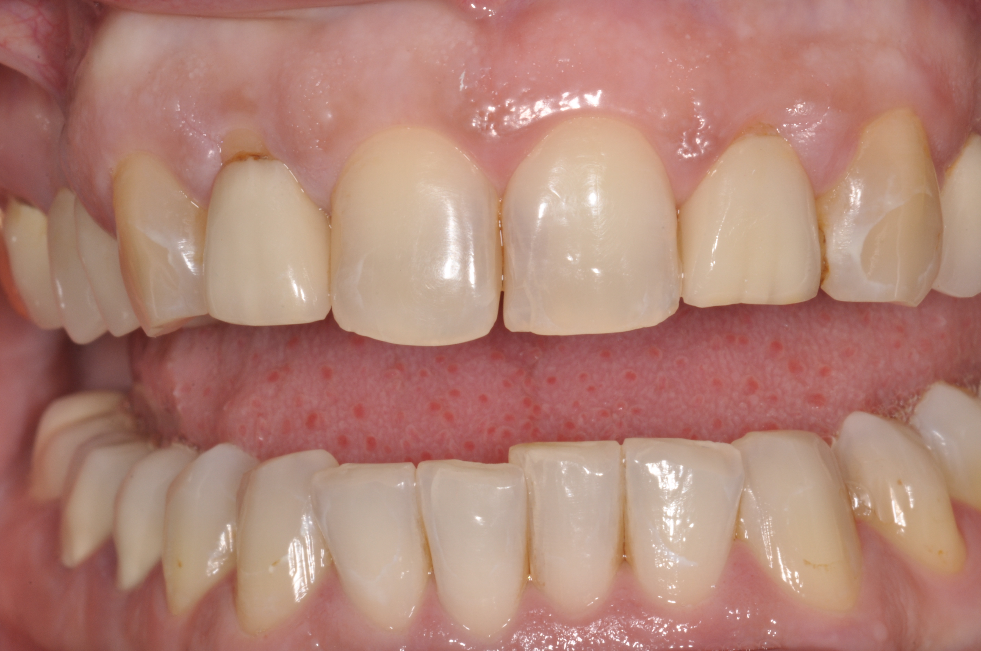 Gelblich/gräulich schimmernde Frontzähne